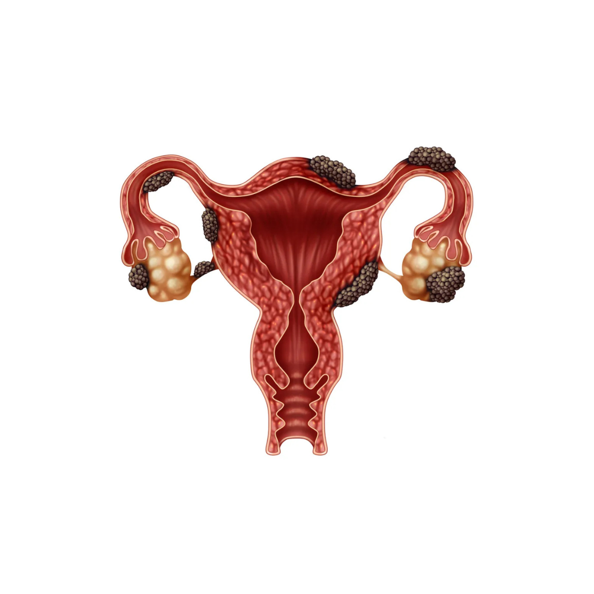 Cirurgia Endometriose